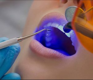 dental light cure